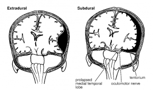 see the excellent 'Primary Surgery' guide for burr hole surgery (reference at the end of this post)