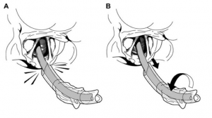 Flip-Flop manoeuvre to avoid R arytenoid hangup when railroading ETT over bougie, via GSA-HEMS