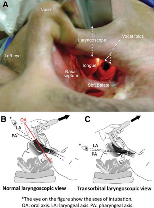 Transorbital